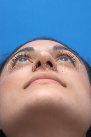 Rhinoplasty Before and After | Sayah Institute