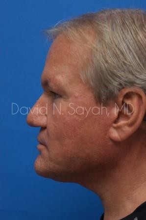 Rhinoplasty Before and After | Sayah Institute