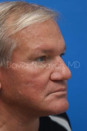 Rhinoplasty Before and After | Sayah Institute