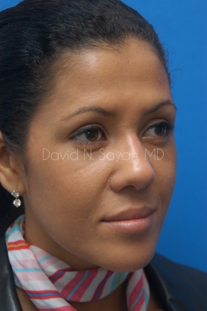 Rhinoplasty Before and After | Sayah Institute