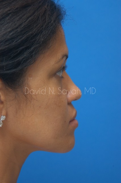 Rhinoplasty Before and After | Sayah Institute