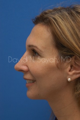 Rhinoplasty Before and After | Sayah Institute