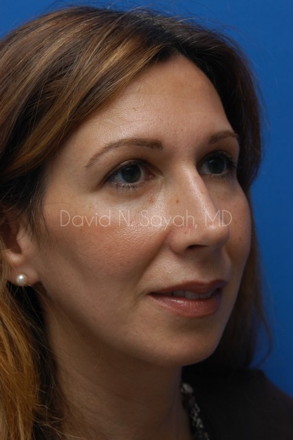 Rhinoplasty Before and After | Sayah Institute