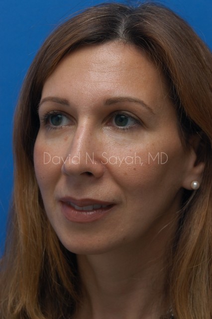 Rhinoplasty Before and After | Sayah Institute