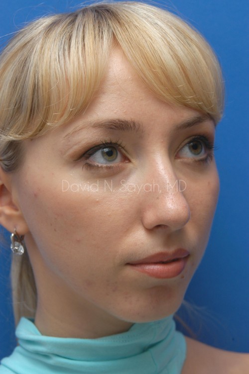 Rhinoplasty Before and After | Sayah Institute