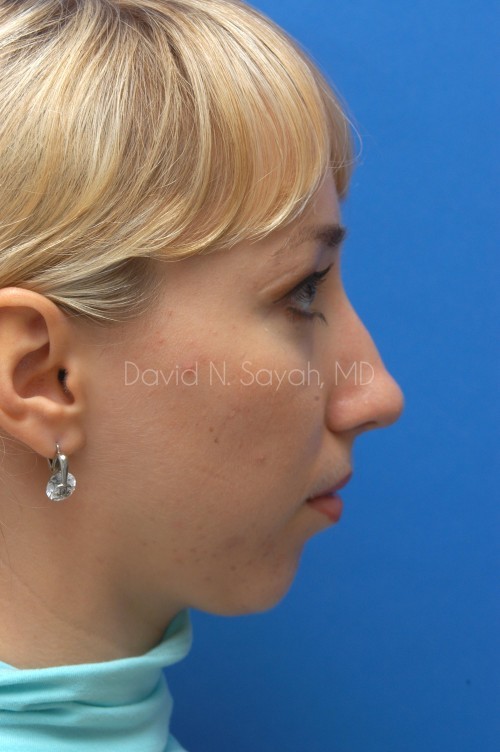Rhinoplasty Before and After | Sayah Institute