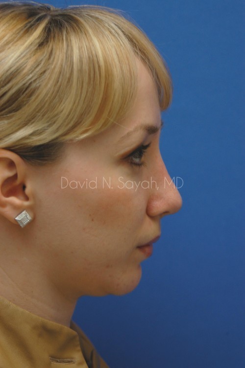 Rhinoplasty Before and After | Sayah Institute