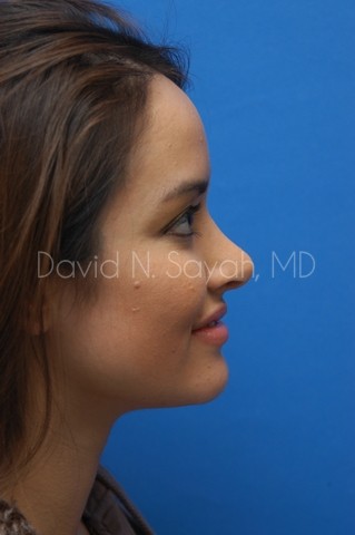 Rhinoplasty Before and After | Sayah Institute