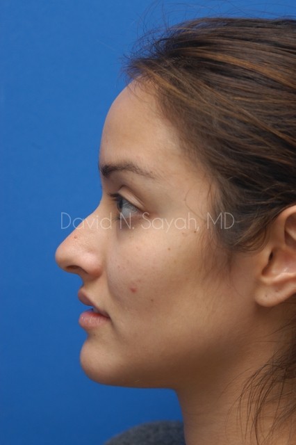 Rhinoplasty Before and After | Sayah Institute