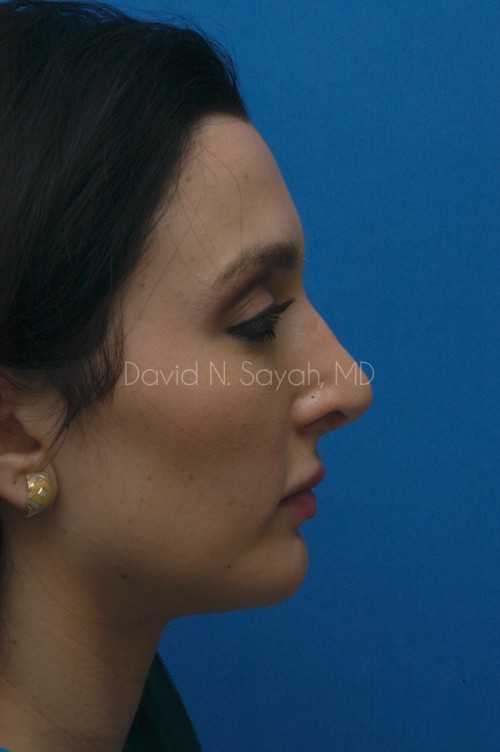 Rhinoplasty Before and After | Sayah Institute