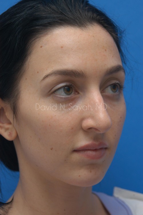 Rhinoplasty Before and After | Sayah Institute