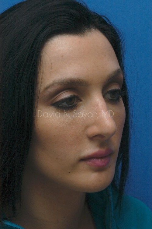 Rhinoplasty Before and After | Sayah Institute