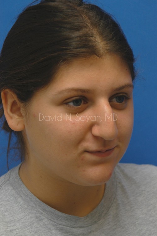 Rhinoplasty Before and After | Sayah Institute