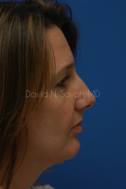 Rhinoplasty Before and After | Sayah Institute