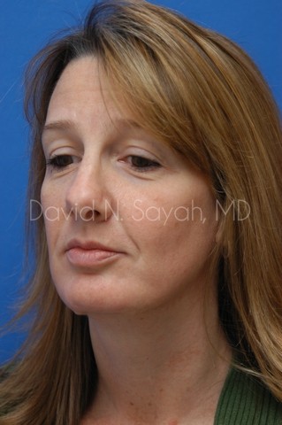 Rhinoplasty Before and After | Sayah Institute