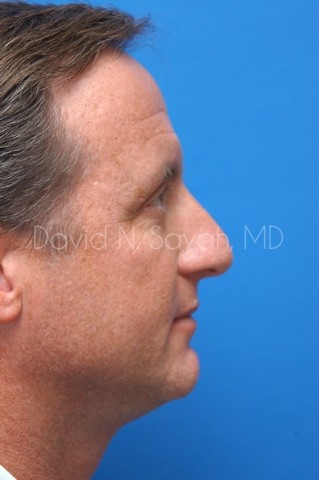 Rhinoplasty Before and After | Sayah Institute