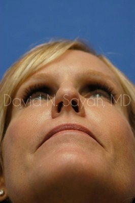 Rhinoplasty Before and After | Sayah Institute