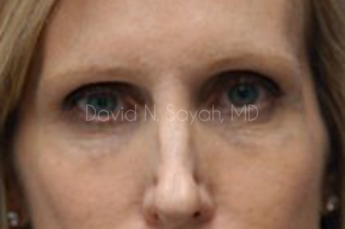 Rhinoplasty Before and After | Sayah Institute