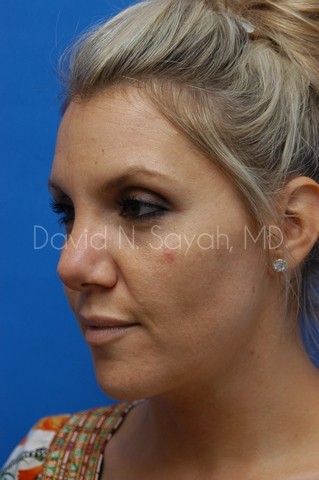 Rhinoplasty Before and After | Sayah Institute