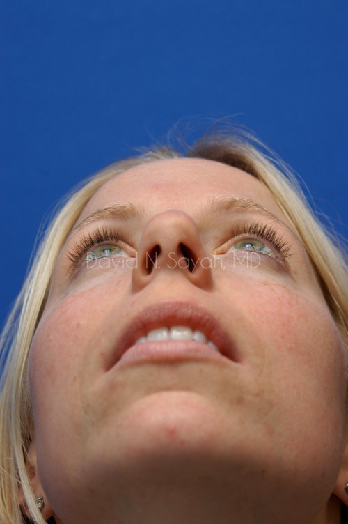 Rhinoplasty Before and After | Sayah Institute