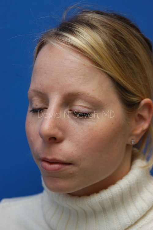 Rhinoplasty Before and After | Sayah Institute