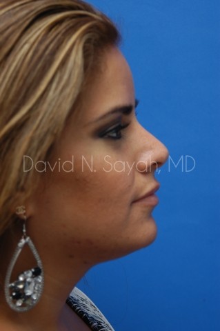 Rhinoplasty Before and After | Sayah Institute