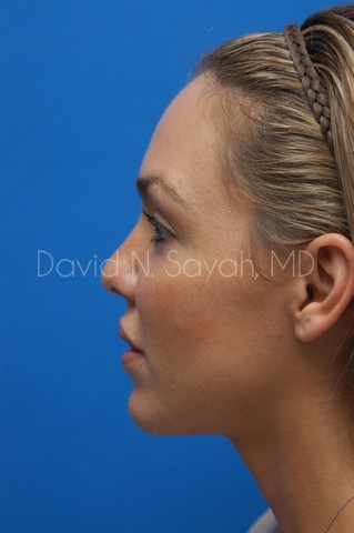 Rhinoplasty Before and After | Sayah Institute