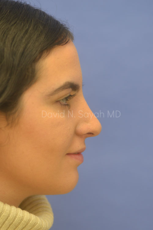 Rhinoplasty Before and After | Sayah Institute
