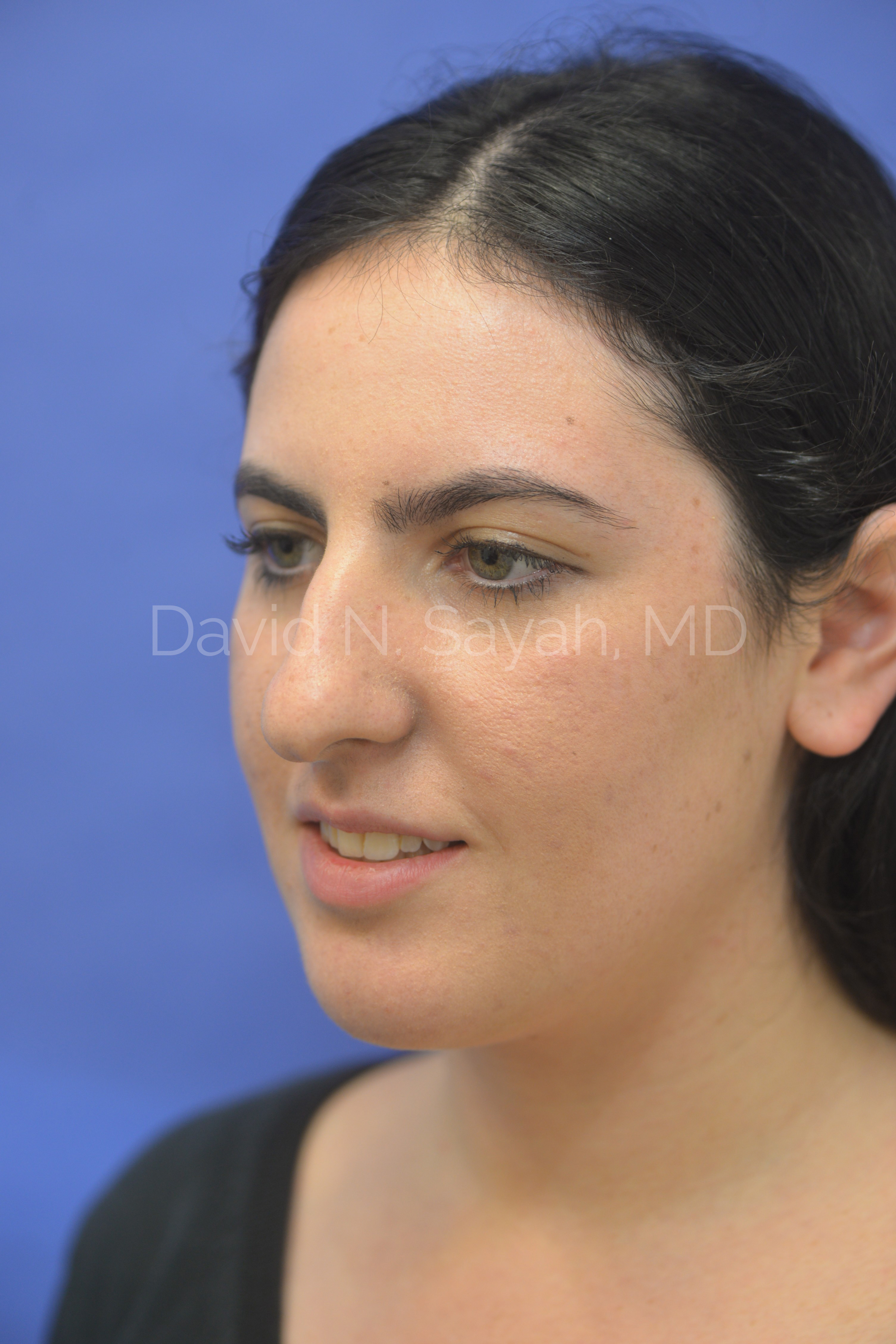 Rhinoplasty Before and After | Sayah Institute
