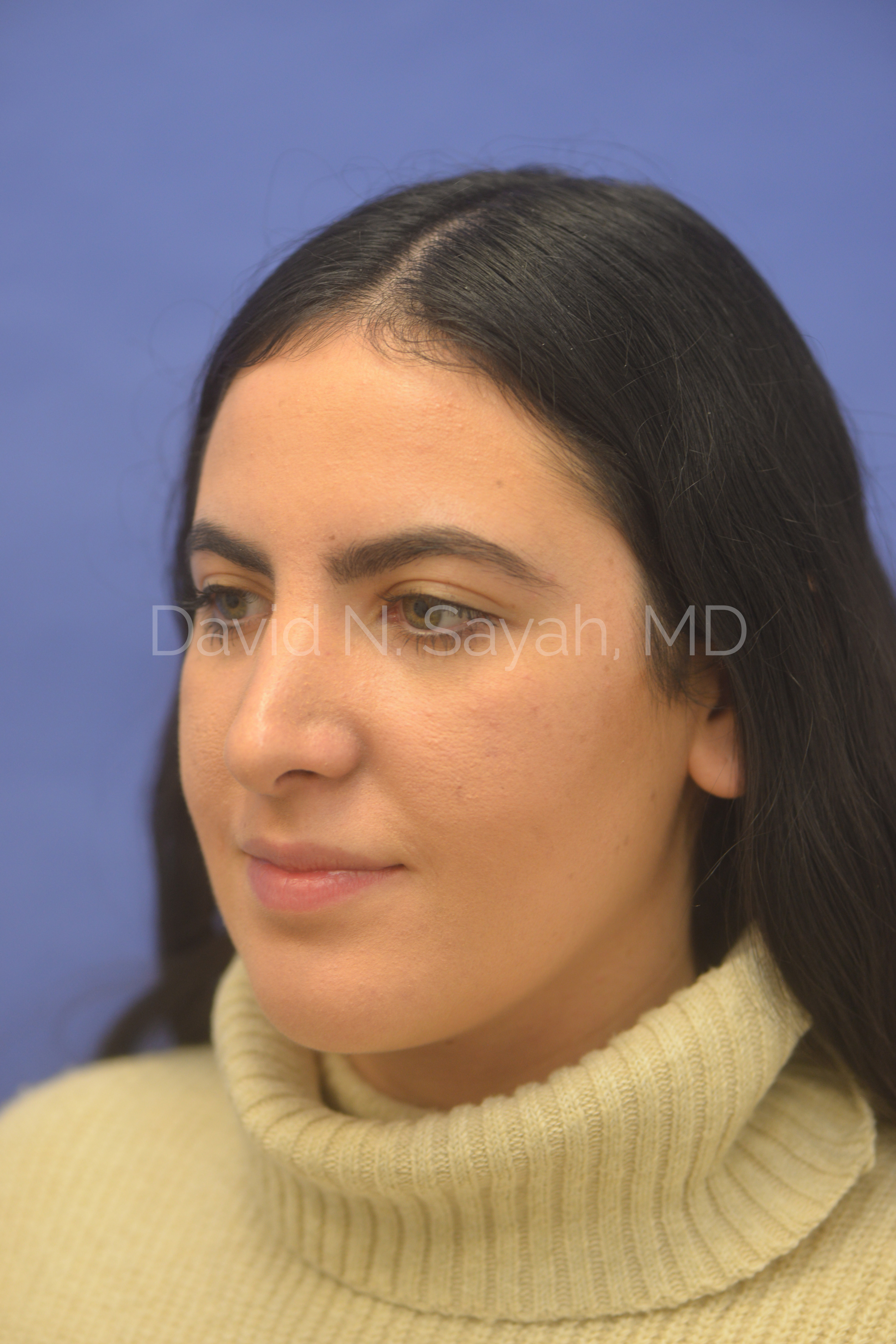 Rhinoplasty Before and After | Sayah Institute
