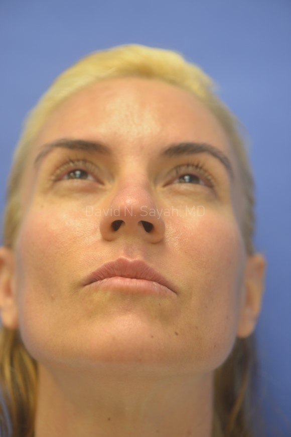 Rhinoplasty Before and After | Sayah Institute