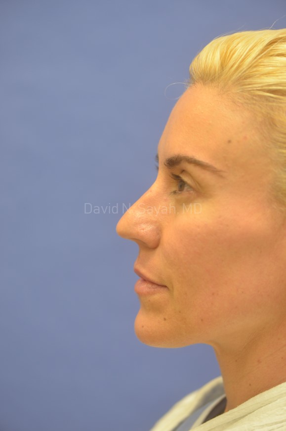 Rhinoplasty Before and After | Sayah Institute