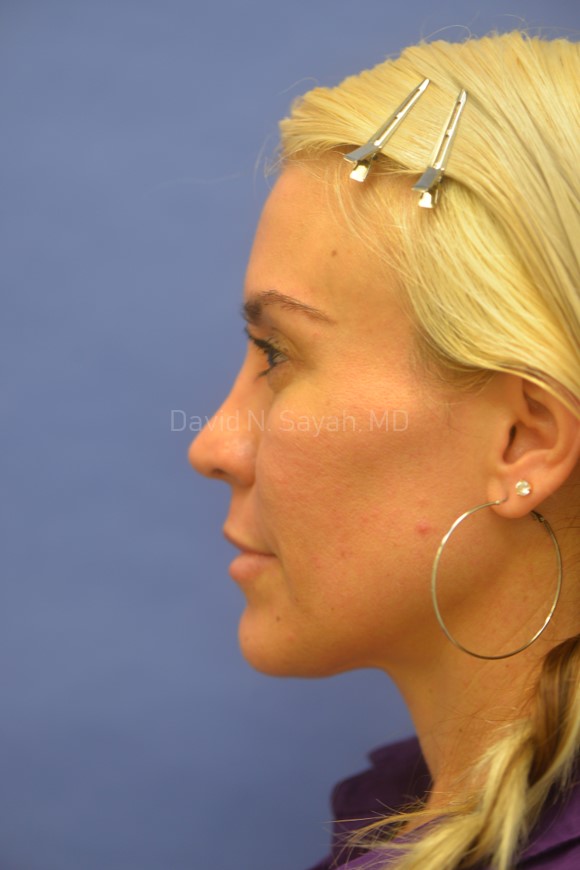 Rhinoplasty Before and After | Sayah Institute