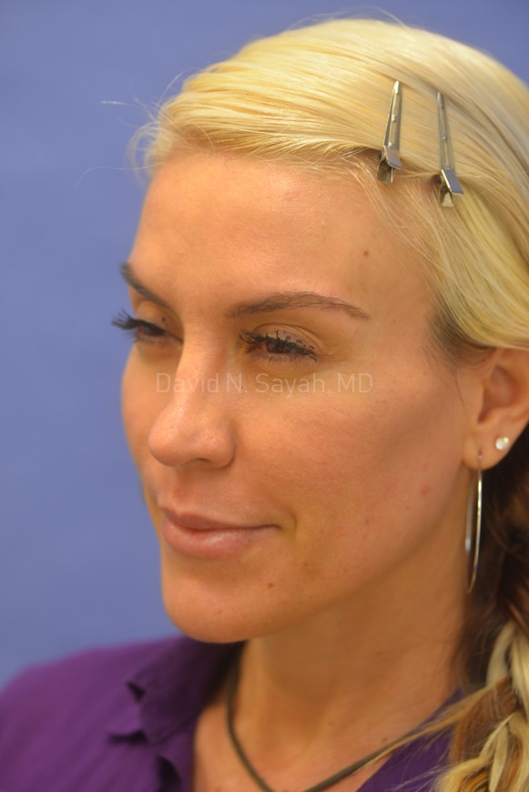 Rhinoplasty Before and After | Sayah Institute