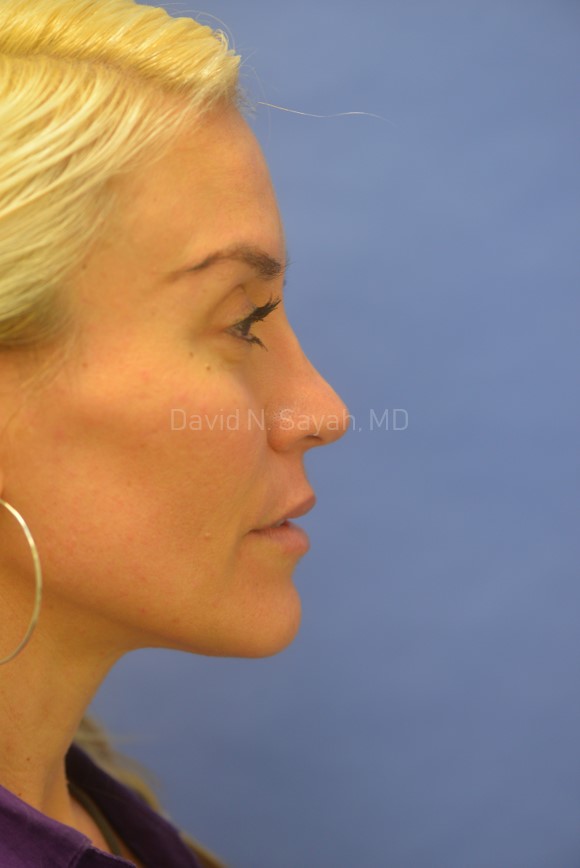 Rhinoplasty Before and After | Sayah Institute