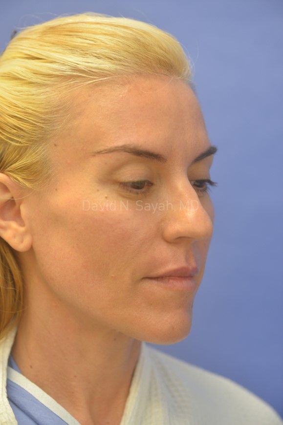 Rhinoplasty Before and After | Sayah Institute