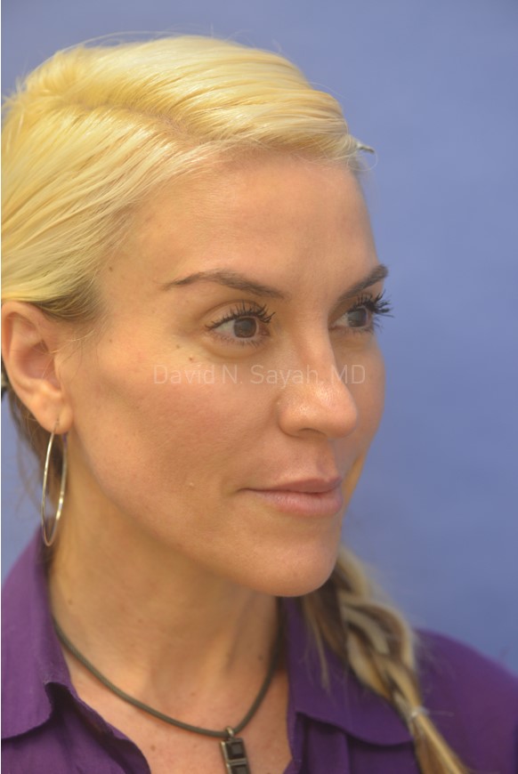 Rhinoplasty Before and After | Sayah Institute