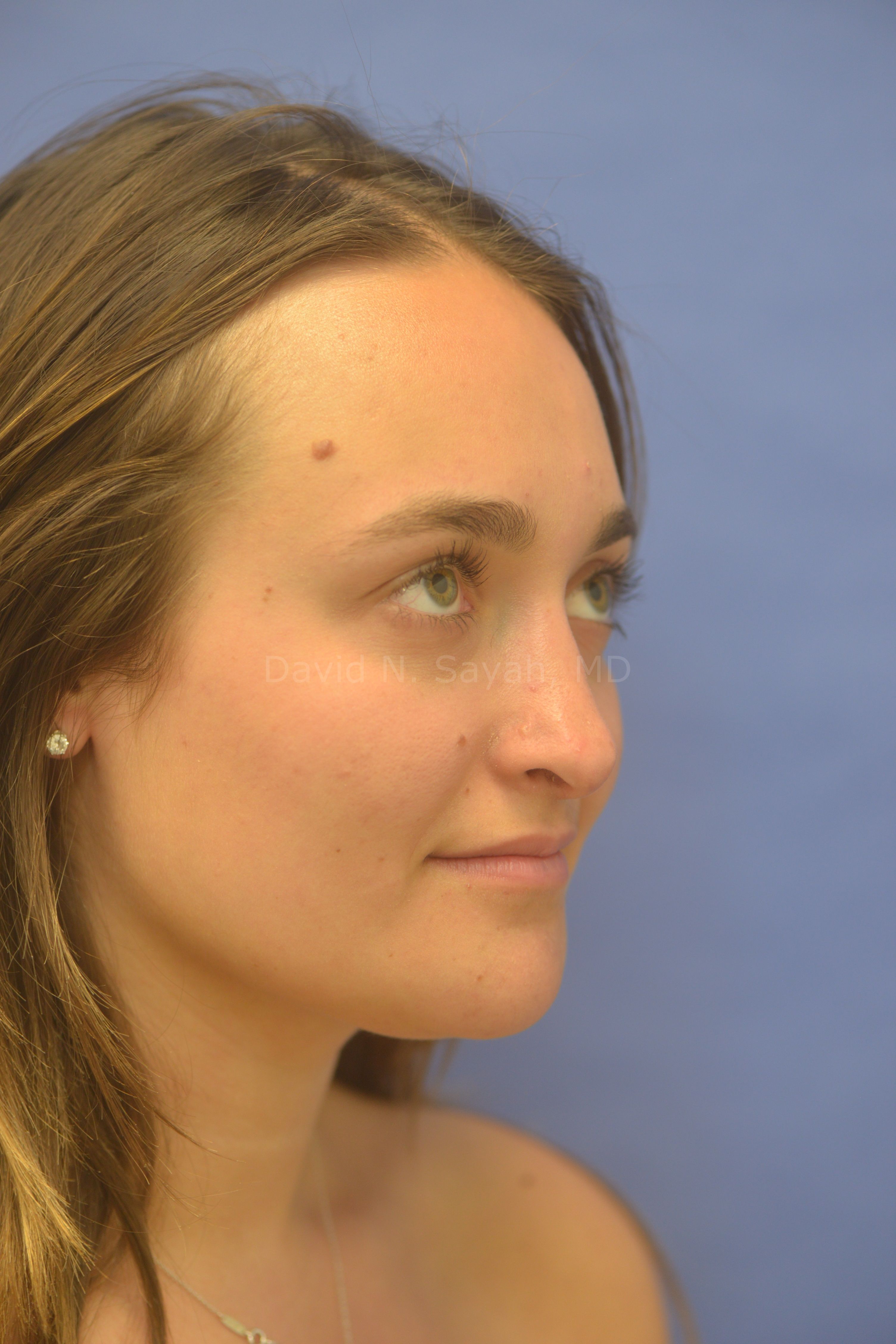 Rhinoplasty Before and After | Sayah Institute