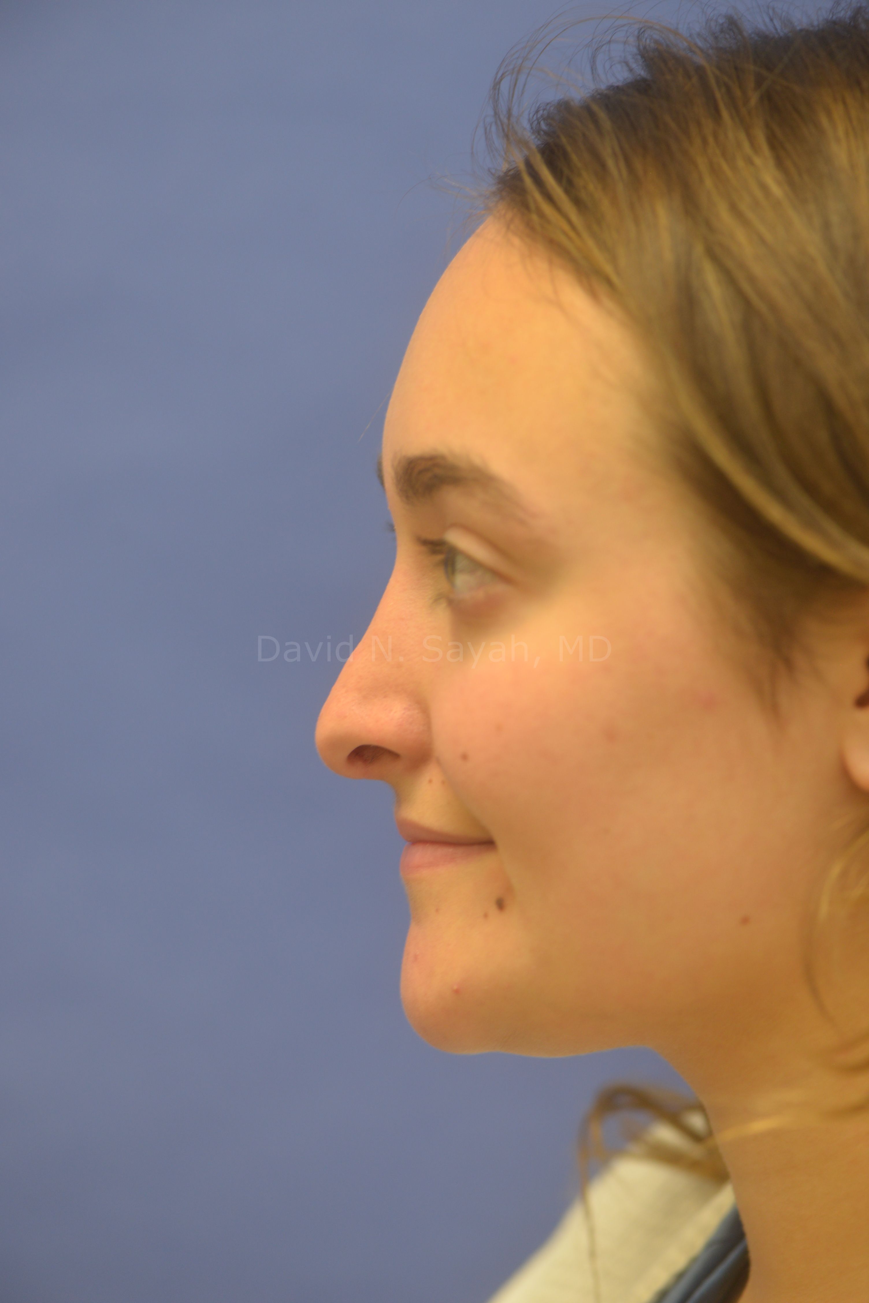 Rhinoplasty Before and After | Sayah Institute
