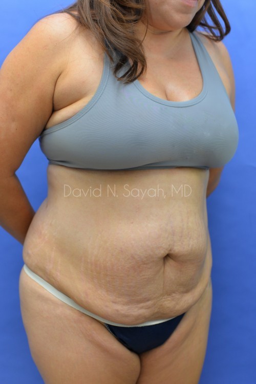 Scar Revision Body Before and After | Sayah Institute