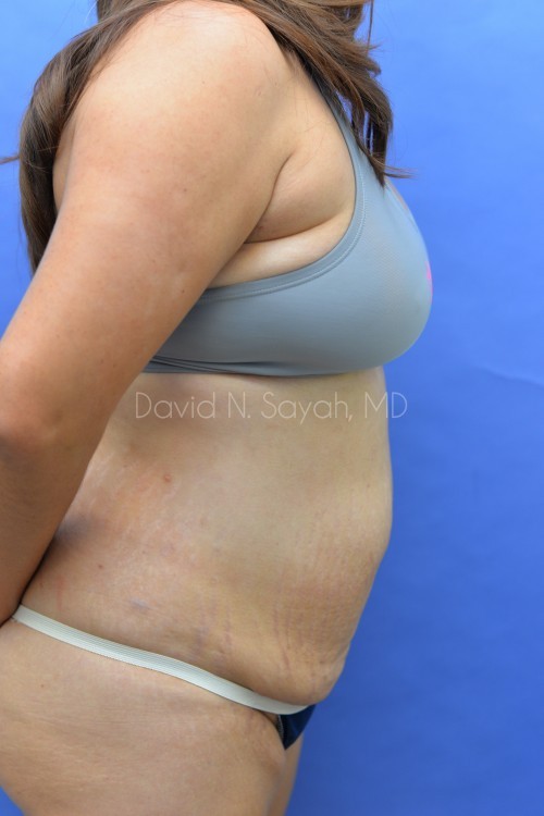 Scar Revision Body Before and After | Sayah Institute