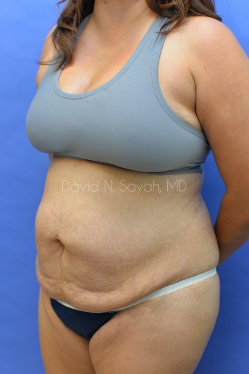 Scar Revision Body Before and After | Sayah Institute