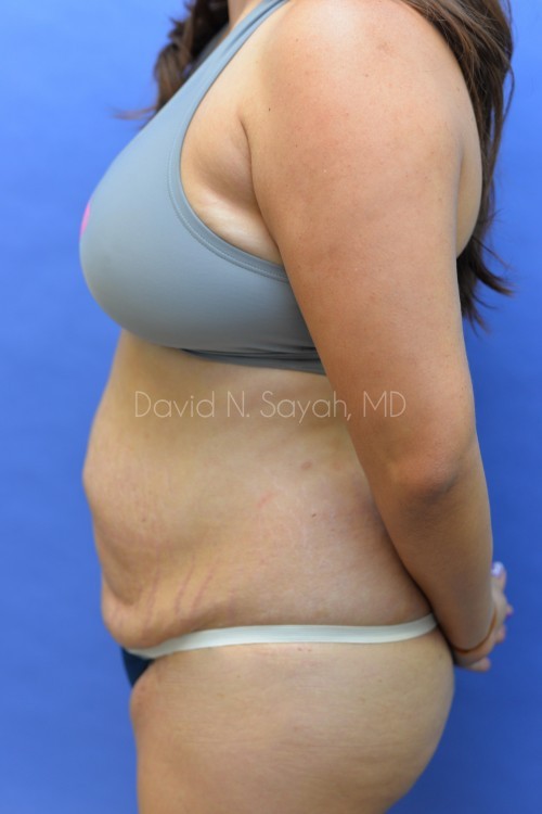 Scar Revision Body Before and After | Sayah Institute