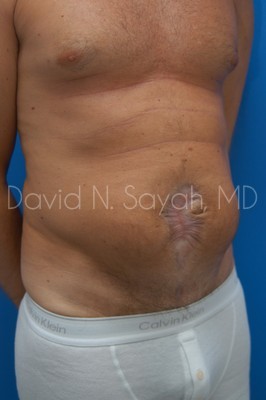 Scar Revision Body Before and After | Sayah Institute