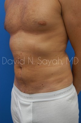Scar Revision Body Before and After | Sayah Institute
