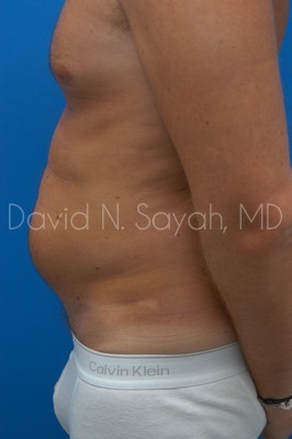 Scar Revision Body Before and After | Sayah Institute