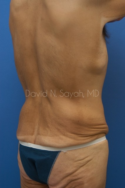 Scar Revision Body Before and After | Sayah Institute
