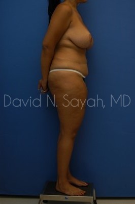 Thigh Lift Before and After | Sayah Institute