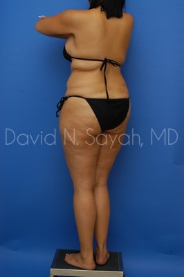 Thigh Lift Before and After | Sayah Institute
