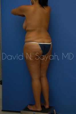 Thigh Lift Before and After | Sayah Institute